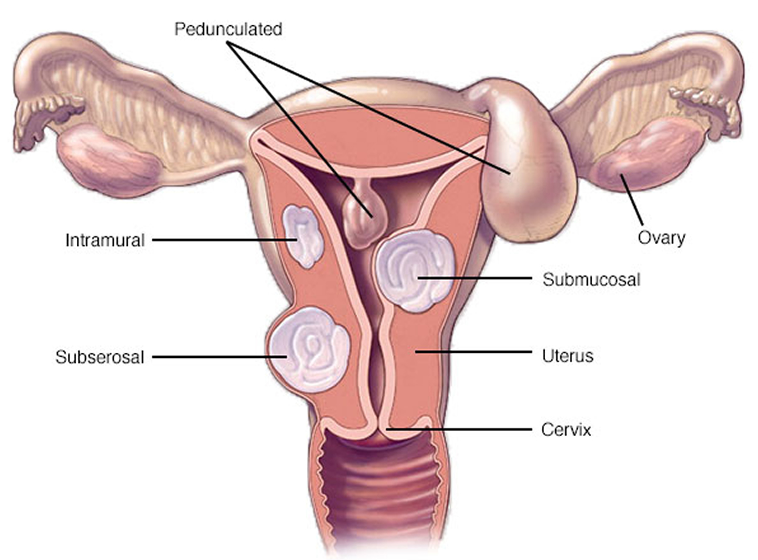 Common Concepts: Causes Of Fibroid Formation And How To Avoid Them
