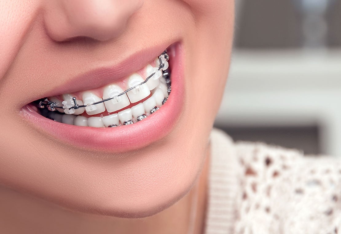 Looking for Clear Braces? Get makeO toothsi Clear Aligner today!